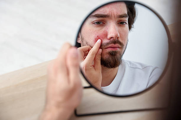 istock Young man with acne problem looking at mirror at table indoors 2239443350