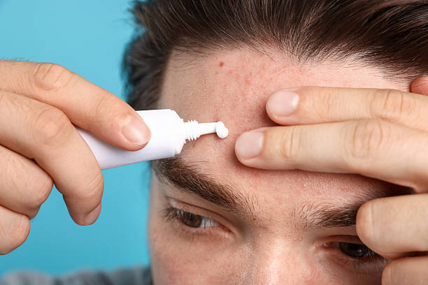 istock Young man with acne problem applying cream onto his face on light blue background, closeup 2239443486