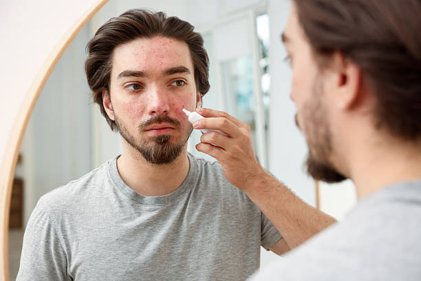 istock Young man with acne problem applying cream onto his face near mirror at home 2239443515