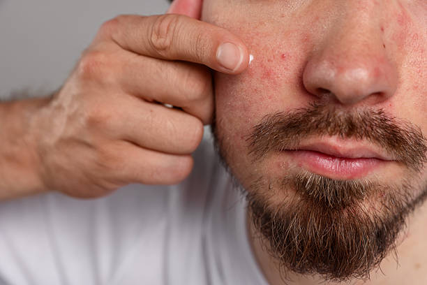 istock Young man with acne problem applying cream onto his face on light grey background, closeup 2239443517