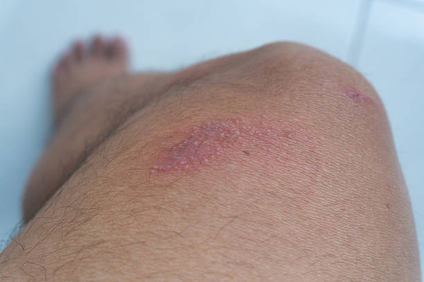 istock Thigh of a man with herpes zoster 2239463712