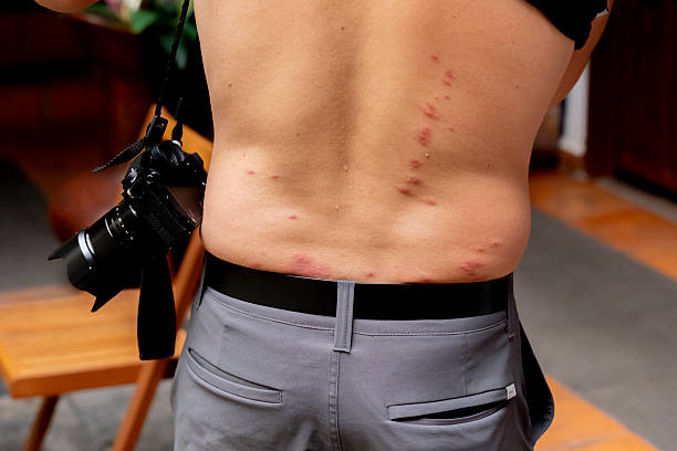 Red welts caused by bedbug bites, which usually appear in irregular or straight lines and disappear on their own after one or two weeks, although it is recommended to use compresses to relieve the stress caused by the itching.