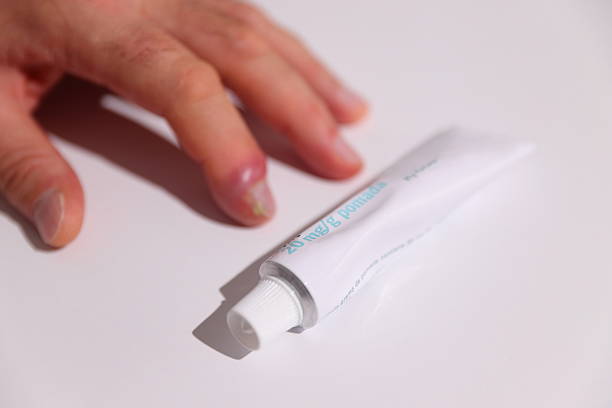 istock Nail inflammation, pus under skin, infection treatment 2239632785