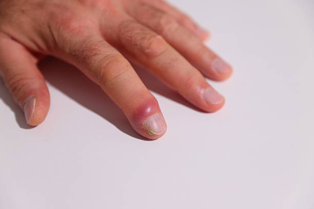 middle finger injured by an ingrown toenail