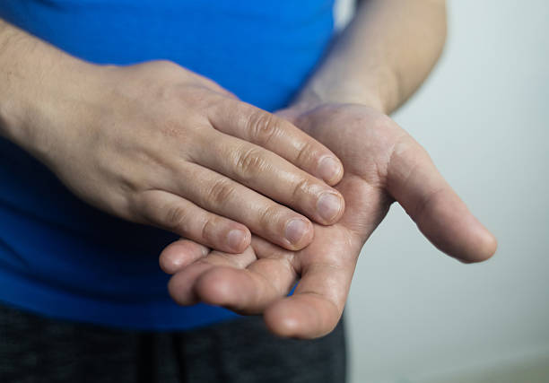 istock A man suffers from palmar hyperhidrosis. He wipes his sweaty palms due to excessive sweating. Treatment of hyperhidrosis with botulinum toxin injection into the hand. 2239906587