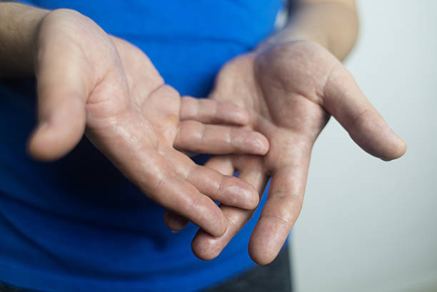 istock A man suffers from palmar hyperhidrosis. He wipes his sweaty palms due to excessive sweating. Treatment of hyperhidrosis with botulinum toxin injection into the hand. 2239906591