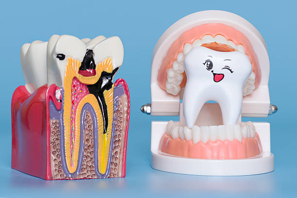 istock dental model showing severe tooth decay beside a smiling winking tooth inside a set of artificial gums 2239950235