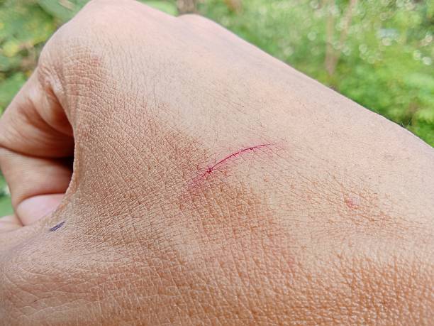 istock Injured skin due to scratches 2240664358