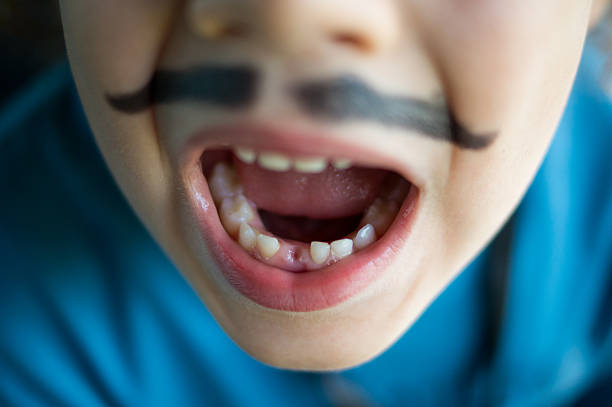 Six-year-old boy with a painted mustache showing his teeth after a tooth has fallen out.