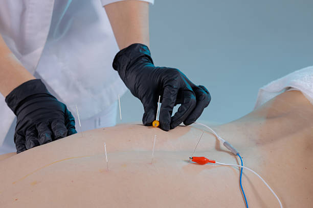 istock Electroacupuncture needles with electrode clips on back for pain therapy 2240842140