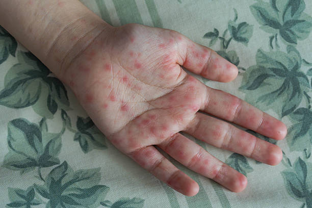 istock a children's hand with foot and mouth disease 2240905685