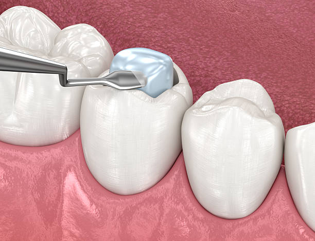 istock Toth restoration with filling. 3D illustration. 2240964457