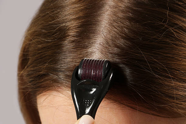 istock Woman using microneedle derma roller on head for stimulating new hair growth. Simple and cheap treatment for the healthy scalp. 2241129939