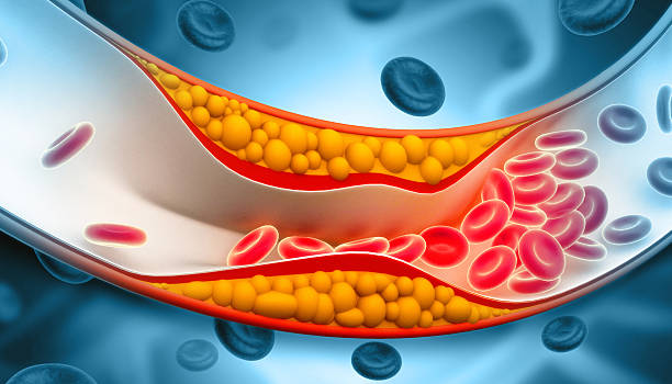 istock Cholesterol plaque in artery on science background. 3d illustration 2241185568