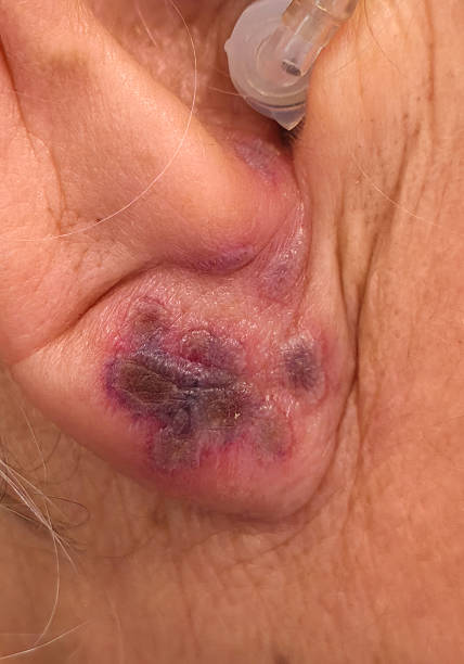 istock shingles sore in the ear,zona , herpes zoster 2241407853