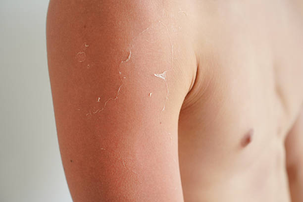 istock A young man with sunburned, peeling skin 2241454722