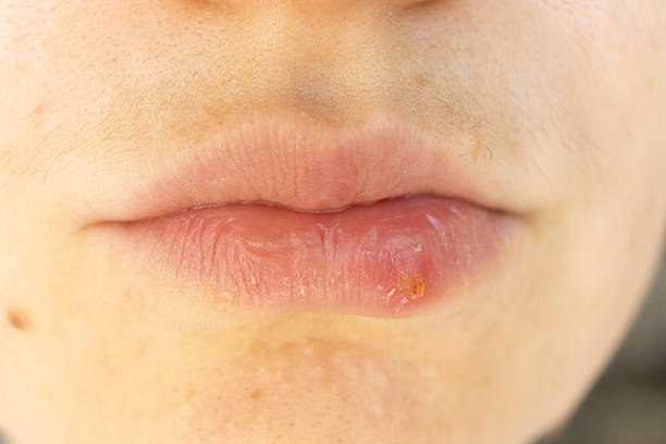 istock Macro Closeup of Herpes on Human Lip. 2241558423