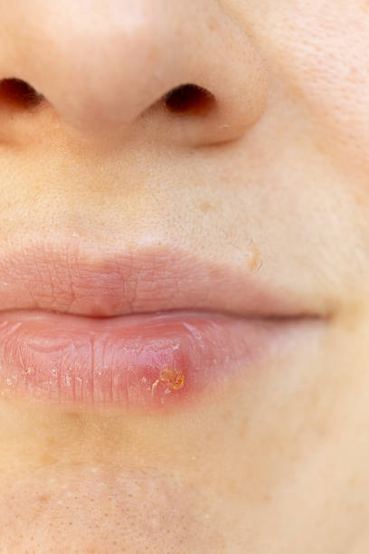 istock Macro Closeup of Herpes on Human Lip. 2241558430