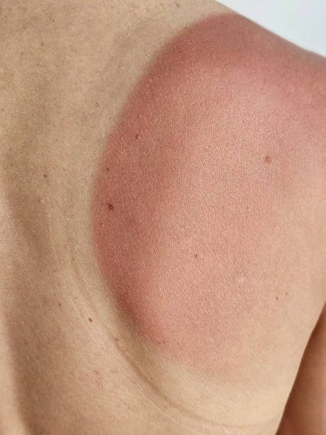 istock Sunburn on shoulder after outdoor activity during summer concept 2241628335