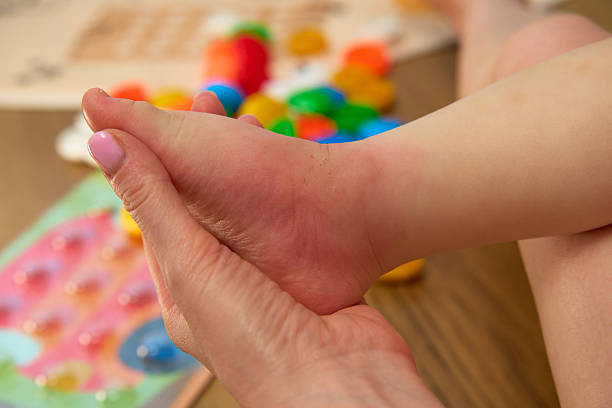istock Visible knee has a distinct red mosquito bite surrounded by slight swelling from outdoor play. 2241663756
