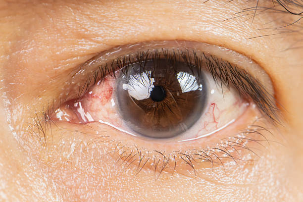 istock Blunt Eye Trauma , An eye impact injury causing potential damage to the eyeball. 2242322122