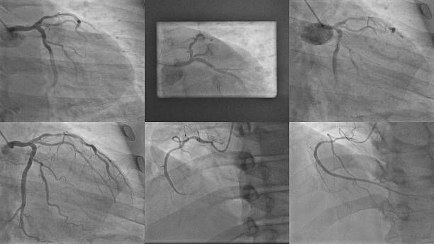 istock Multiview Coronary Angiography Demonstrating Coronary Artery 2242515512