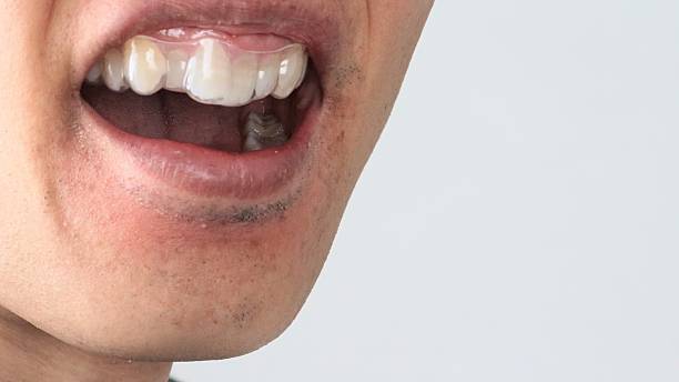 istock A person wearing an orthodontic mouthpiece 2243134491