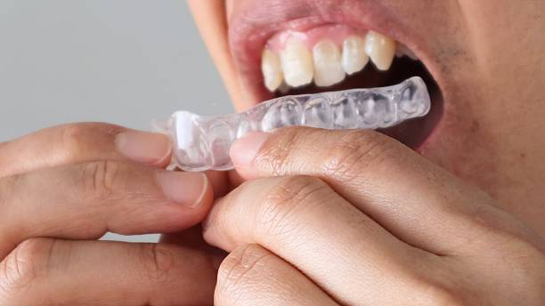 istock A person wearing a mouthguard on their teeth 2243134529