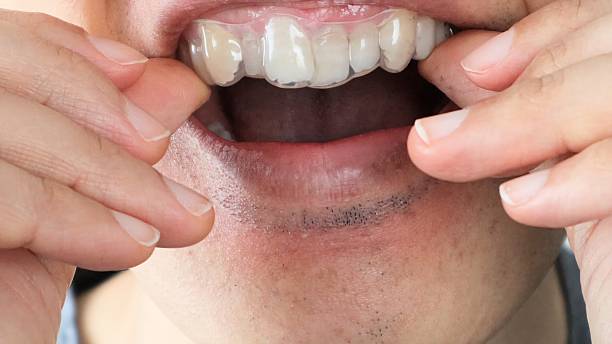 istock A person wearing a mouthpiece for orthodontics 2243134536