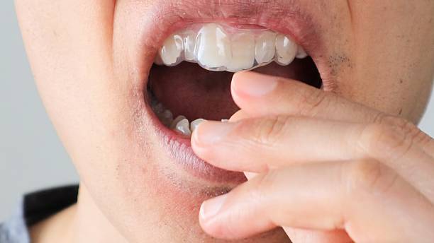 istock A person wearing a mouthpiece for orthodontics 2243134542