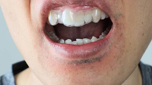 istock A person wearing an orthodontic mouthpiece 2243134543