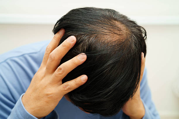 istock Bald head in man, hair loss treatment health problem. 2243141525
