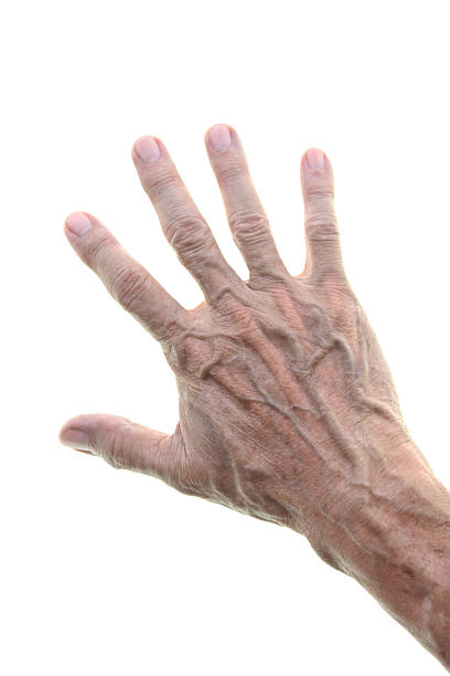 Swollen hands left hand
