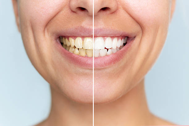 istock Young woman before and after teeth whitening close-up. Half-smile comparison 2243174945