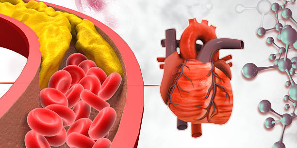 istock Human heart with Blocked blood vessel, cholesterol blocking artery 2243181667
