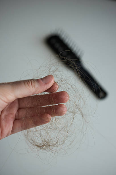 istock Hair loss 2243273815