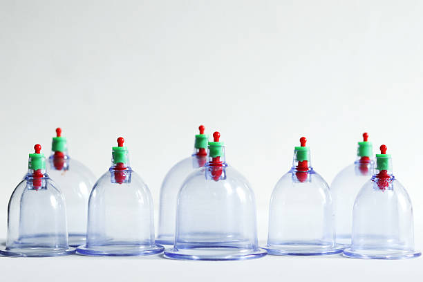 Close-up of a patient undergoing cupping therapy on his back, a traditional alternative medicine practice