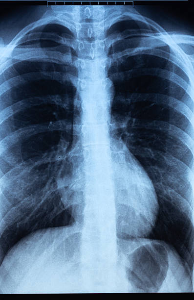 Medical chest X-ray image with a highlighted area, representing healthcare, diagnosis, respiratory system, cancer diagnosis and medical imaging.
