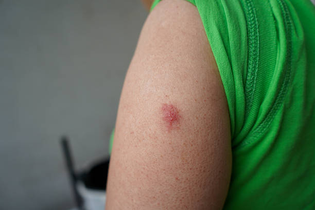 Vaccination mark on human skin after receiving an immunization shot.