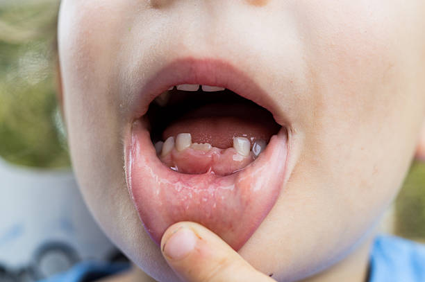 istock Boy with his mouth open showing a growing tooth 2243838853