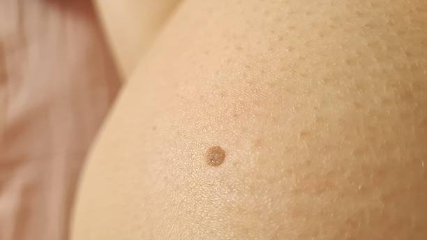 istock Macro Skin Detail: Close-Up of a Mole with Natural Skin Texture 2243967593