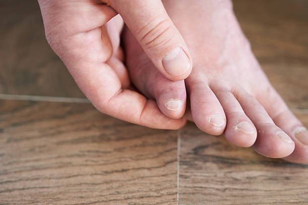 istock Bruise and contusion on his little toe. 2244287158