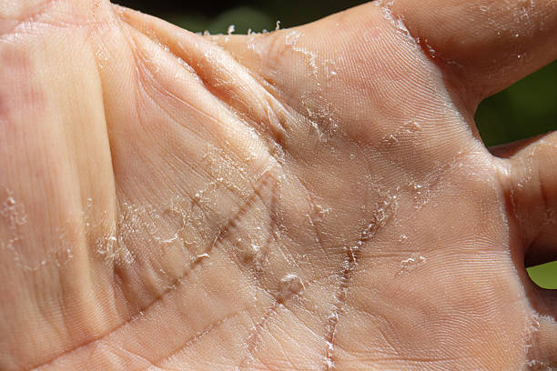 istock Skin peeling due to an allergic reaction. 2244409442