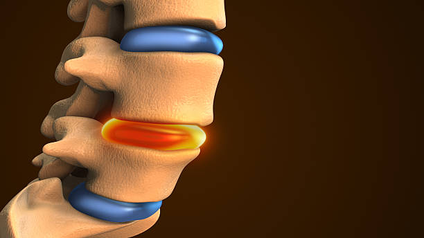 istock Spinal Disc Herniation Shown in Medical Animation 2244587237