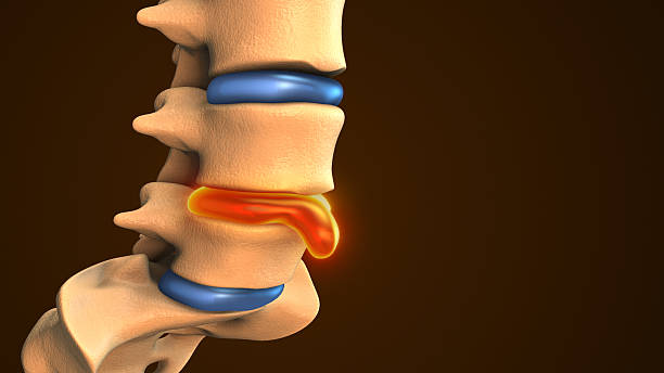istock Spinal Disc Herniation Shown in Medical Animation 2244587238