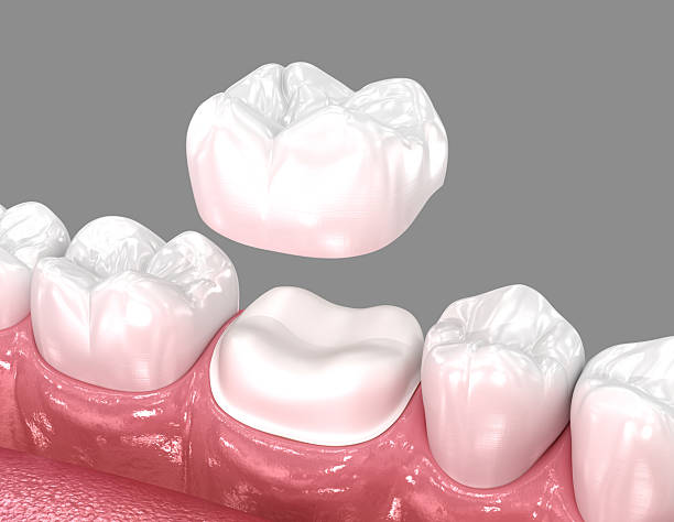 istock Dental crown placement over tooth. 3D illustration 2245153040