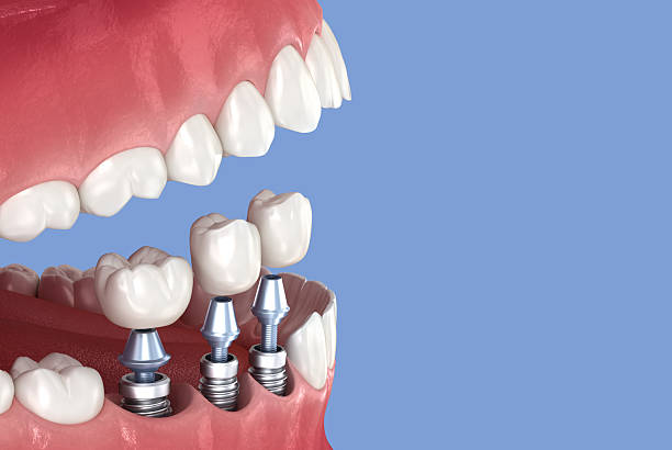 istock Tooth crowns placement over 3 implants. Dental 3D illustration 2245153047