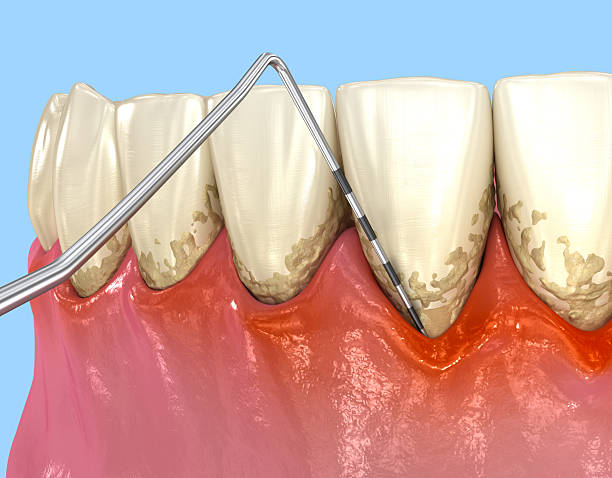 istock Gum recession test. Dental3D illustration 2245153054