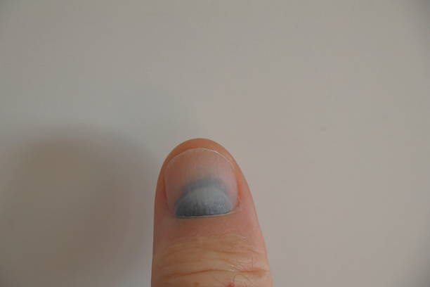 A finger is shown against a plain white background. The nail is painted with blue nail polish, which partially covers the nail, leaving part of it unpainted. The finger's texture is smooth, with visible natural lines. The image focuses on the tip of the finger, highlighting the contrast between the blue nail polish and the natural nail color.