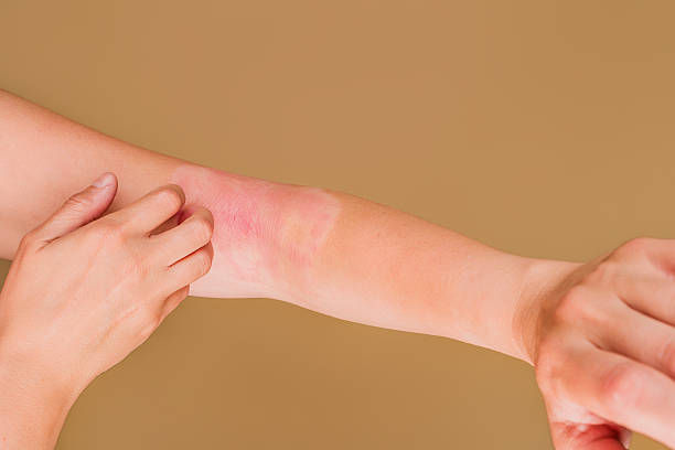 istock Woman scratching itchy red arm skin rash 2245376711